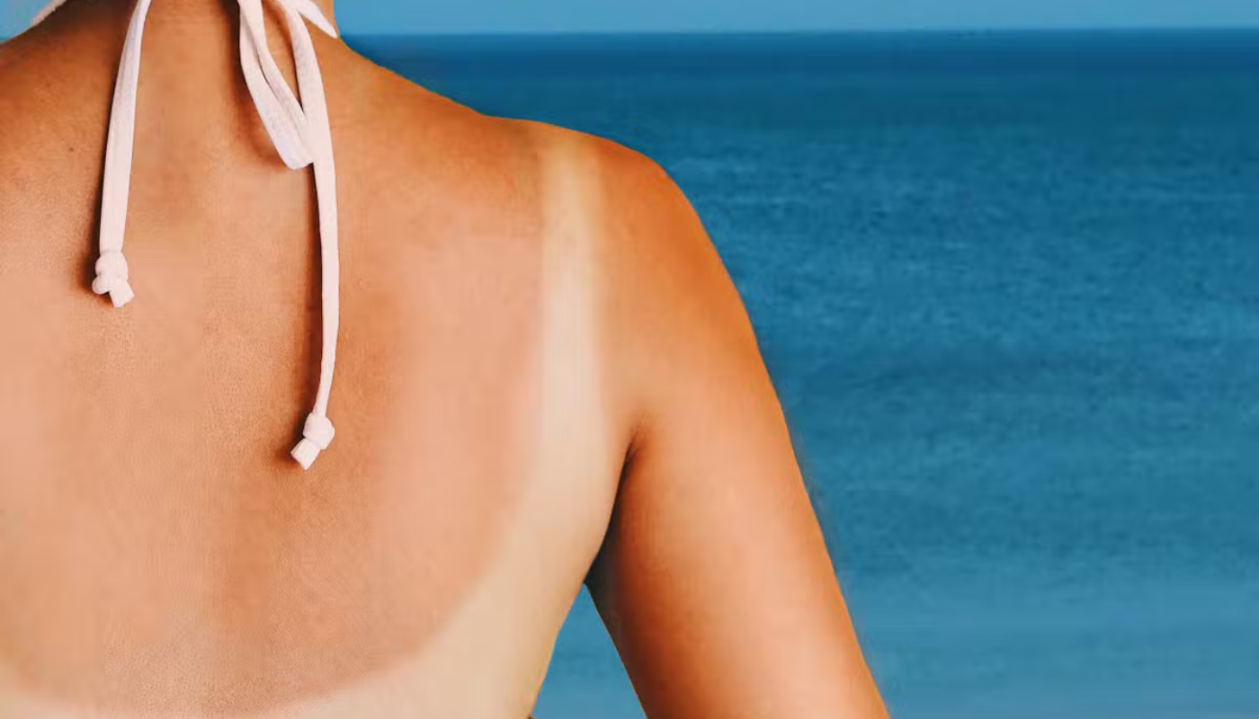 how do you turn a sunburn into a tan